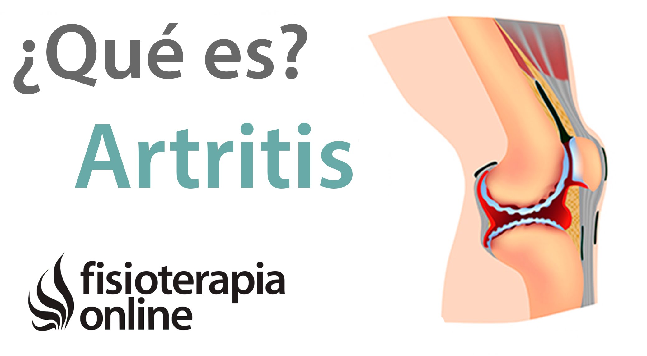 ¿Existe una relación entre padecer artritis y la depresión?